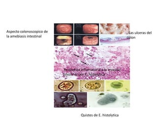 Aspecto colonoscopico de
la amebiasis intestinal
, Las ulceras del
colon
Respuesta inflamatoria a la invasión
intestinal por E. histolytica
Quistes de E. histolytica
 