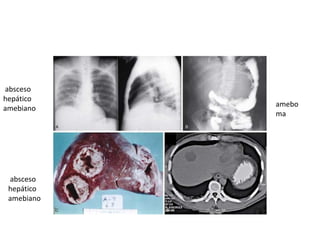 absceso
hepático
amebiano
absceso
hepático
amebiano
amebo
ma
 