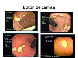 Botón de camisa
Parasitología Médica. 3a tercera
edición. Marco Antonio Becerril Flores. |
McGraw-Hill 2013, Español.
 