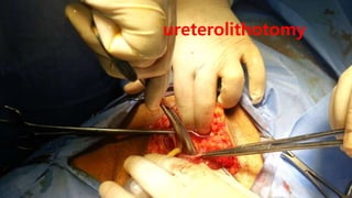 ureterolithotomy
 
