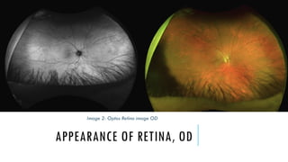 Amelanotic Choroidal Nevus - Case Presentation by Toqua Saflo | PPTX