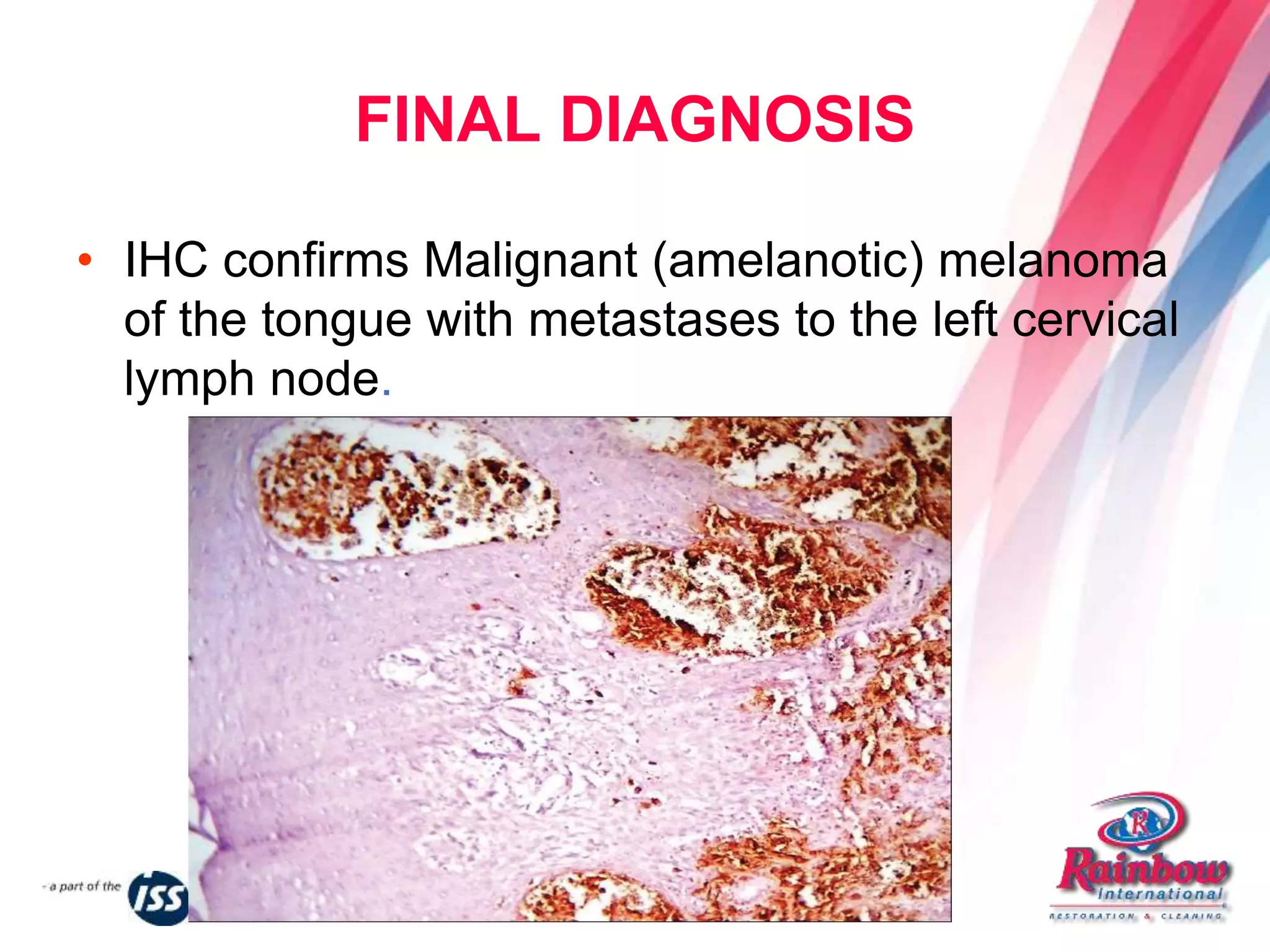Amelanotic melanoma of the tongue | PPTX