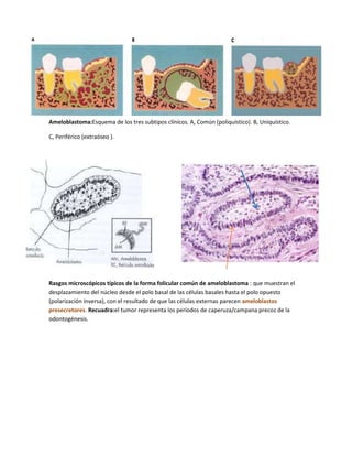 Ameloblastoma:Esquema de los tres subtipos clínícos. A, Común (poliquístico). B, Uniquístico.

C, Periférico (extraóseo ).




Rasgos microscópicos típicos de la forma folicular común de ameloblastoma : que muestran el
desplazamiento del núcleo desde el polo basal de las células basales hasta el polo opuesto
(polarización inversa), con el resultado de que las células externas parecen ameloblastos
presecretores. Recuadra:el tumor representa los períodos de caperuza/campana precoz de la
odontogénesis.
 