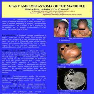 GIANT AMELOBLASTOMA OF THE MANDIBLE
                                 ABBAS A , Renaux A , Pochan Y , Faye A , Sissoko B
                                               1              2              3           2              2
                                           1
                                            ENT Resident of Marseille – CHU Timone - (France) aliabbas@yahoo.fr                  2

                                         Department of ENT – Hospital Principal – Dakar (Senegal)
                                                            3
                                                              Department of Stomatology – Hospital Principal – Dakar (Senegal)


                  An ameloblastoma is an            odontogenic
tumour of epithelial origin that can be locally aggressive, with a
variety of histologic appearances. A relatively uncommon tumor
(reported incidence: 3 per 10 million), it has a predilection for
the mandible, and it accounts for approximately 1% of all
tumours and cysts that occur in the jaw.


BACKGROUND: In developed countries, ameloblastoma is
usually treated early, so these tumours do not normally reach
sufficient size to qualify as a giant ameloblastoma jaw. We
                                                                                        Fig 1a & 1b: giant ameloblastoma
report the case of a 39-year-old woman who had a massive                                of the mandible
recurrent ameloblastoma of the mandible. Our case is reported
because of its rarity, size, and       management in under-
medicalized countries, which involved radical resection.

MATERIAL AND METHODS : A 39-year-old                     woman
was admitted to the hospital with an 8-year history of a growing
mass in her left, with a recurrence after partial surgery –without
precision- 6 years ago (Fig 2). The tumour measured 20 x 12 x
13 cm, blowed out the left hemi-mandible and the maxillary
bone. It was firm, painless, polylobed, with a normal skin,
and without nervous expression or           cervical     lymphatic
metastasis. CT-Scan     showed a heterogenous and polycystic                          Fig 2: scar after prior partial surgery
tumour, with several cortical disjunctions, blowing out the                           6 years ago
mandible,      the maxillary and palatine bones until the
pterygopalatine area (Fig 3). Ameloblastoma was also heavily
suspected.

RESULTS:          Surgical management entailed the resection
of the entire left mandible and right symphysis, a part of the
maxillary sinus and palatine process, not followed by
reconstruction (Fig 4 & 5).
                  There was no         incident in postoperative
days and a second intervention of           reconstruction was
scheduled (Fig 6a, 6b & 6c). Nevertheless the patient had never
come.
                                                                                      Fig 3: CT Scan: polycystic pattern
                  The    pathological    study    revealed    a
                                                                                      of ameloblastoma
 