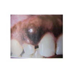 Ameloblastoma