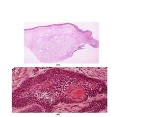 Ameloblastoma