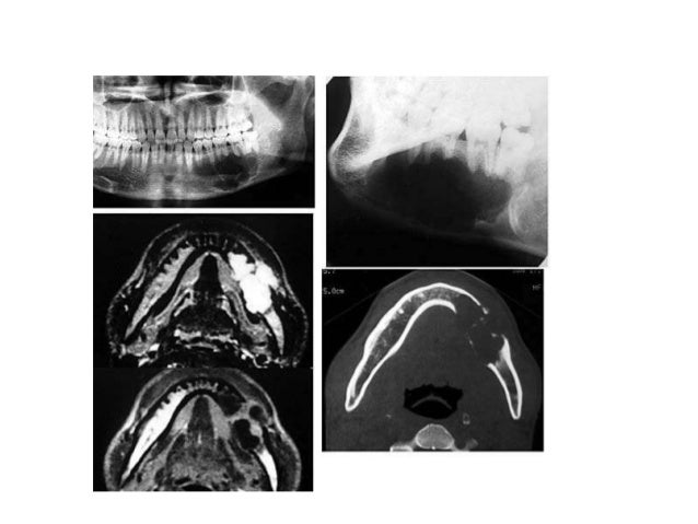 Ameloblastoma