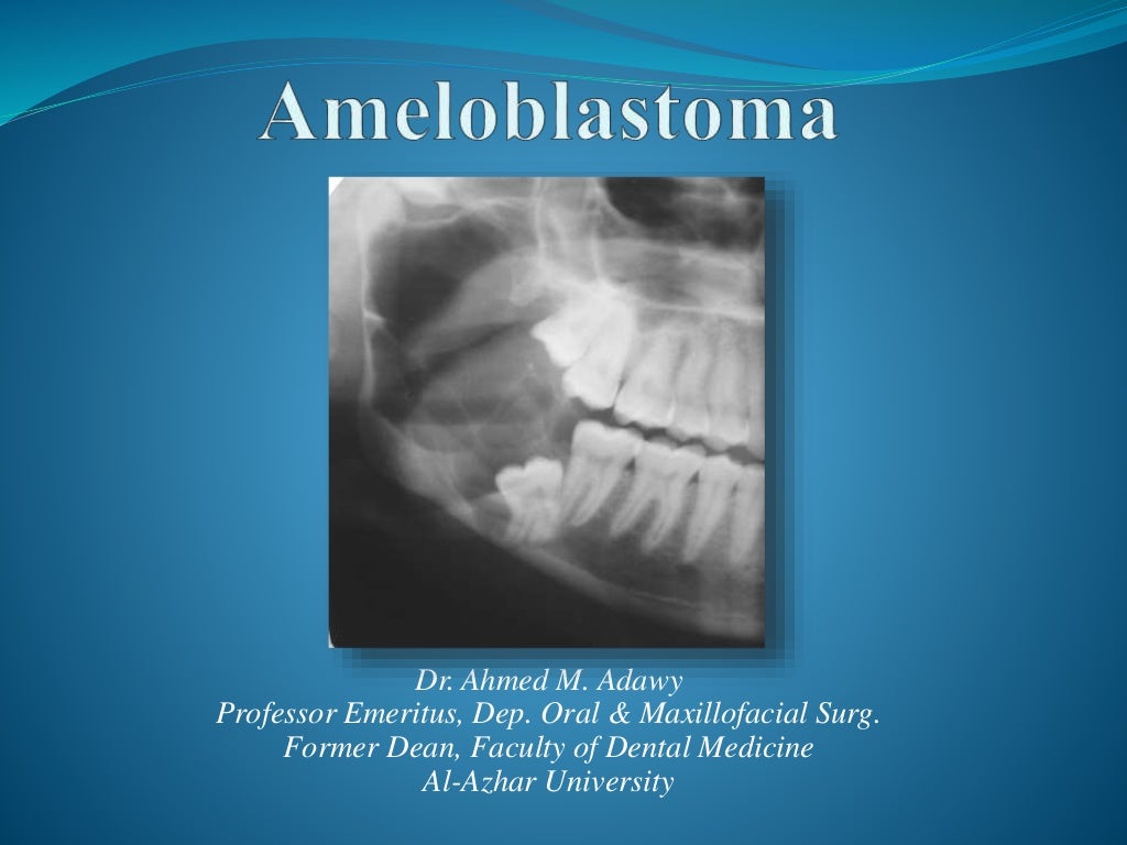 Ameloblastoma