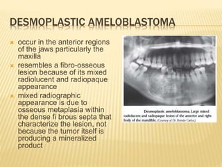 DESMOPLASTIC AMELOBLASTOMA
 occur in the anterior regions
of the jaws particularly the
maxilla
 resembles a fibro-osseous
lesion because of its mixed
radiolucent and radiopaque
appearance
 mixed radiographic
appearance is due to
osseous metaplasia within
the dense fi brous septa that
characterize the lesion, not
because the tumor itself is
producing a mineralized
product
 