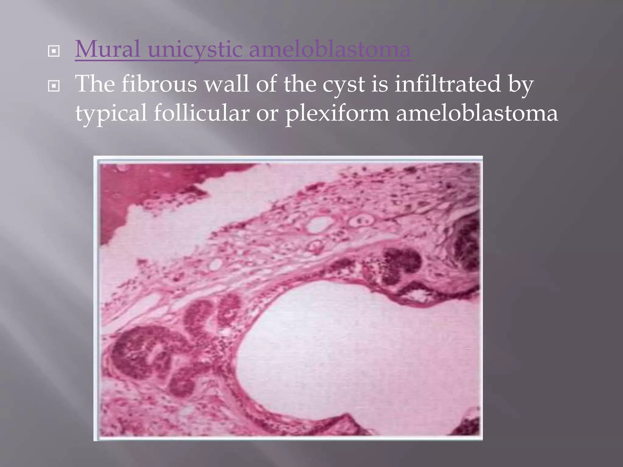 Ameloblastoma | PPTX