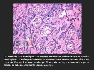 Figura 8.

Do ponto de vista histológico, são tumores constituídos exclusivamente de epitélio
odontogênico. O parênquima do tumor se apresenta como massas celulares sólidas ou
como cordões ou ilhas cujas células periféricas, via de regra, assumem o aspecto
colunar ou cuboidal semelhante aos ameloblastos.
 