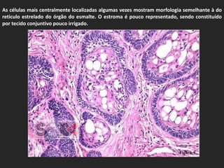 As células mais centralmente localizadas algumas vezes mostram morfologia semelhante à do
reticulo estrelado do órgão do esmalte. O estroma é pouco representado, sendo constituído
por tecido conjuntivo pouco irrigado.




                                                                       Figura. 9
 
