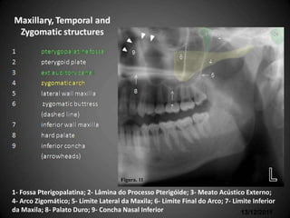 Partes Ósseas envolvidas com
   seus respectivos nomes em inglês




                                      Figura. 11

1- Fossa Pterigopalatina; 2- Lâmina do Processo Pterigóide; 3- Meato Acústico Externo;
4- Arco Zigomático; 5- Limite Lateral da Maxila; 6- Limite Final do Arco; 7- Limite Inferior
da Maxila; 8- Palato Duro; 9- Concha Nasal Inferior                             13/12/2011
 