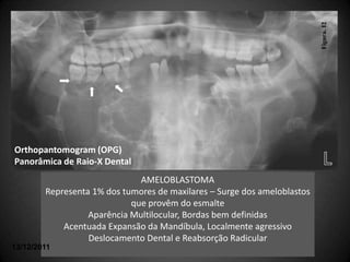 Figura. 12
         Orthopantomogram (OPG)




Orthopantomogram (OPG)
Panorâmica de Raio-X Dental
                              AMELOBLASTOMA
        Representa 1% dos tumores de maxilares – Surge dos ameloblastos
                            que provêm do esmalte
                  Aparência Multilocular, Bordas bem definidas
            Acentuada Expansão da Mandíbula, Localmente agressivo
                  Deslocamento Dental e Reabsorção Radicular
13/12/2011
 