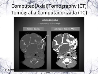 Computed(Axial)Tomography (CT)
       Tomografia Computadorizada (TC)

             Janelas ósseas                Janelas de Tecidos Moles




13/12/2011
                              Figura. 13
 