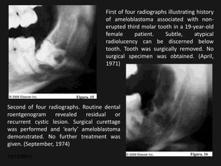 First of four radiographs illustrating history
                                       of ameloblastoma associated with non-
                                       erupted third molar tooth in a 19-year-old
                                       female       patient.   Subtle,       atypical
                                       radiolucency can be discerned below
                                       tooth. Tooth was surgically removed. No
                                       surgical specimen was obtained. (April,
                                       1971)




                          Figura. 15

Second of four radiographs. Routine dental
roentgenogram revealed        residual   or
recurrent cystic lesion. Surgical curettage
was performed and ‘early’ ameloblastoma
demonstrated. No further treatment was
given. (September, 1974)
                                                                           Figura. 16
13/12/2011
 