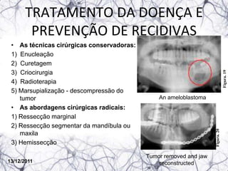 TRATAMENTO DA DOENÇA E
       PREVENÇÃO DE RECIDIVAS
 • As técnicas cirúrgicas conservadoras:
 1) Enucleação
 2) Curetagem




                                                                                Figura. 19
 3) Criocirurgia
 4) Radioterapia
 5) Marsupialização - descompressão do
    tumor                                      An ameloblastoma
 • As abordagens cirúrgicas radicais:
 1) Ressecção marginal
 2) Ressecção segmentar da mandíbula ou




                                                                   Figura. 20
    maxila
 3) Hemissecção

                                           Tumor removed and jaw
13/12/2011                                     reconstructed
 