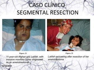 CASO CLÍNICO
               SEGMENTAL RESECTION




                 Figura. 21                                   Figura. 22

    11-year-old Afghan girl, Latifah, with   Latifah recovering after resection of her
    massive maxillary tumor diagnosed        ameloblastoma
    as an ameloblastoma.
13/12/2011
 