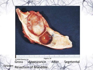 Figura. 24

             Gross    Appearance    After   Segmental
13/12/2011
             Resection of Mandible.
 
