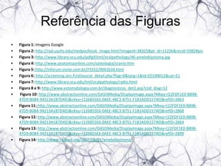 Referência das Figuras
•   Figura 1: Imagens Google
•   Figura 2: http://rad.usuhs.edu/medpix/kiosk_image.html?imageid=38325&pt_id=11236&recid=5982#pic
•   Figura 3: http://www.library.vcu.edu/pdfgif/tml/oralpathology/46-ameloblastoma.jpg
•   Figura 4: http://www.anatomiaonline.com/osteologia/cranio.htm
•   Figura 5: http://inforum.insite.com.br/73352/9041634.html
•   Figura 6: http://screening.iarc.fr/atlasoral_detail.php?flag=0&lang=1&Id=E0100011&cat=E1
•   Figura 7: http://www.library.vcu.edu/tml/oralpathology/radio.html
•   Figura 8 e 9: http://www.estomatologia.com.br/diagnosticos_det2.asp?cod_diag=12
•   Figura 10: http://www.abstractsonline.com/OASISMedia/DisplayImage.aspx?Mkey={22FDF1E0-BB98-
    47D9-B084-94213A1B7D4D}&cKey={126B55E6-0AEE-48C3-B751-F1B1ADD15740}&refID=2863
•   Figura 11: http://www.abstractsonline.com/OASISMedia/DisplayImage.aspx?Mkey={22FDF1E0-BB98-
    47D9-B084-94213A1B7D4D}&cKey={126B55E6-0AEE-48C3-B751-F1B1ADD15740}&refID=2868
•   Figura 12: http://www.abstractsonline.com/OASISMedia/DisplayImage.aspx?Mkey={22FDF1E0-BB98-
    47D9-B084-94213A1B7D4D}&cKey={126B55E6-0AEE-48C3-B751-F1B1ADD15740}&refID=2864
•   Figura 13: http://www.abstractsonline.com/OASISMedia/DisplayImage.aspx?Mkey={22FDF1E0-BB98-
    47D9-B084-94213A1B7D4D}&cKey={126B55E6-0AEE-48C3-B751-F1B1ADD15740}&refID=2899
•   Figura 14: http://www.radpod.org/2007/08/01/ameloblastoma/
 
