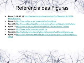 Referência das Figuras
•   Figura 15, 16, 17, 18: http://www.pathconsultddx.com/pathCon/diagnosis?pii=S1559-
    8675(06)70616-7
•   Figura 19: http://scw.asahi-u.ac.jp/~kawamata/jpg/amelo2.jpg
•   Figura 20: http://www.odontologiadiferenciada.com.br/?cont=unilocularameloblastoma
•   Figura 21: http://www.asahq.org/Newsletters/2007/01-07/javernick01_07.html
•   Figura 22: http://www.asahq.org/images/jave7.jpg
•   Figura 23: http://upload.wikimedia.org/wikipedia/commons/c/c3/Ameloblastoma.jpg
•   Figura 24: http://www.pathconsultddx.com/pathCon/diagnosis?pii=S1559-8675(06)70616-
    7#fig1
 