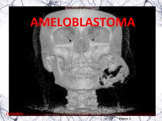 AMELOBLASTOMA




13/12/2011
                        Figura. 2
 