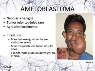 AMELOBLASTOMA
• Neoplasia benigna
• Tumor odontogênico raro
• Agressivo localmente

• Incidência:
    – Manifesta-se igualmente em
      ambos os sexos
    – Mais frequente em torno dos 30
      anos
    – É indiferente a um ou outro grupo
      étnico.
                                          Figura. 3

13/12/2011
 
