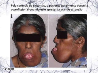 Pela carência de sintomas, o paciente geralmente consulta
       o profissional quando este apresenta grande extensão.




                                                         Figura. 6

13/12/2011
 