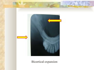 Bicortical expansion 