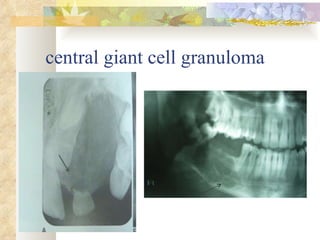 central giant cell granuloma 
