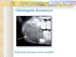 Odontogenic Keratocyst Right body and ramus of the mandible 