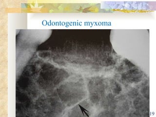 03/27/10 Odontogenic myxoma 