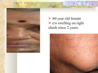 60 year old female c/o swelling on right cheek since 2 years.  