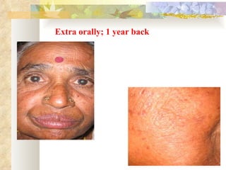 Extra orally; 1 year back 