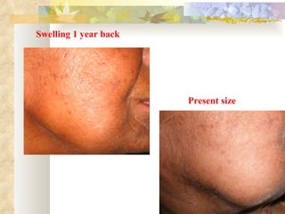 Swelling 1 year back Present size 
