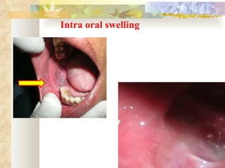 Intra oral swelling 