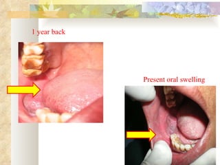 1 year back Present oral swelling 