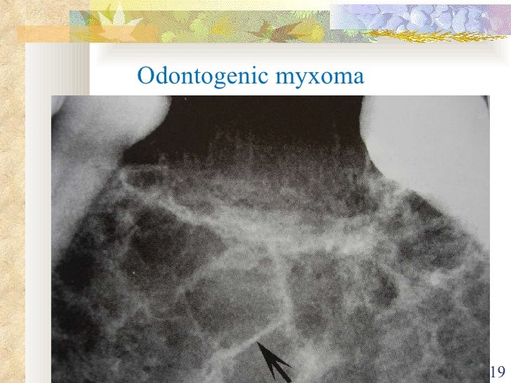 Ameloblastoma