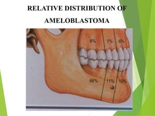 RELATIVE DISTRIBUTION OF
AMELOBLASTOMA
 