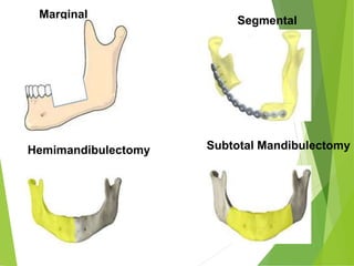 Marginal
Segmental
Subtotal Mandibulectomy
Hemimandibulectomy
 
