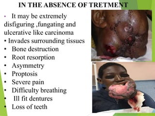 • It may be extremely
disfiguring ,fungating and
ulcerative like carcinoma
• Invades surrounding tissues
• Bone destruction
• Root resorption
• Asymmetry
• Proptosis
• Severe pain
• Difficulty breathing
• Ill fit dentures
• Loss of teeth
IN THE ABSENCE OF TRETMENT
 