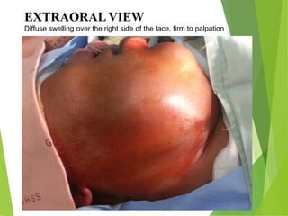 EXTRAORAL VIEW
Diffuse swelling over the right side of the face, firm to palpation
 
