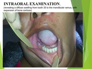 INTRAORAL EXAMINATION.
(revealing a diffuse swelling from tooth 35 to the mandibular ramus, with
expansion of bone cortices)
 