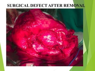 SURGICAL DEFECT AFTER REMOVAL
 