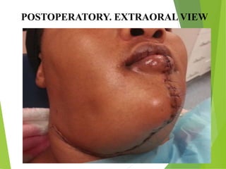 POSTOPERATORY. EXTRAORAL VIEW
 