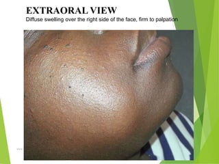 09/30/17
www.stuffamia.com
EXTRAORAL VIEW
Diffuse swelling over the right side of the face, firm to palpation
 