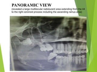 PANORAMIC VIEW
(revealed a large multilocular radiolucent area extending from the 44
to the right coronoid process including the ascending ramus area)
 