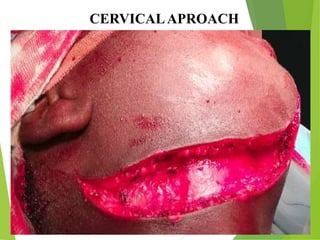 CERVICALAPROACH
 