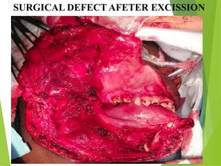 SURGICAL DEFECT AFETER EXCISSION
 