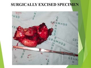 SURGICALLY EXCISED SPECIMEN
 
